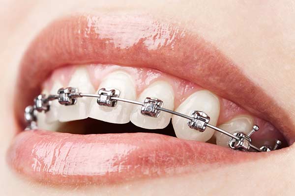 Parts of Braces  Innovative Orthodontic Centers