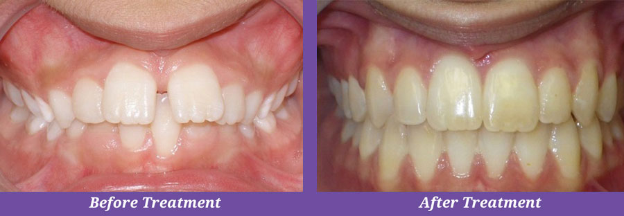 before and after orthodontic treatment photos