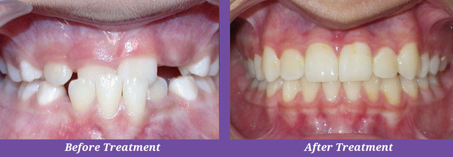 before and after image of patient teeth
