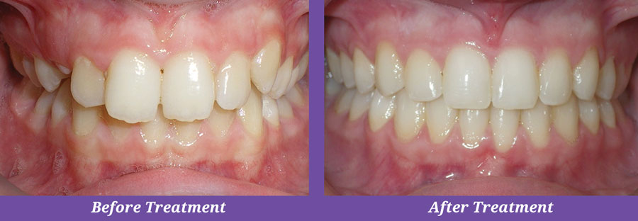 before and after treatment of crooked teeth