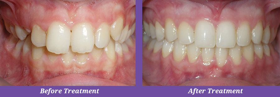 before and after treatment of crooked teeth