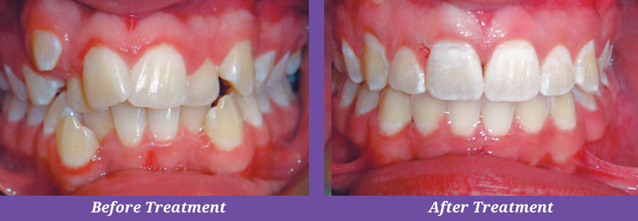 before and after treatment of crowded teeth
