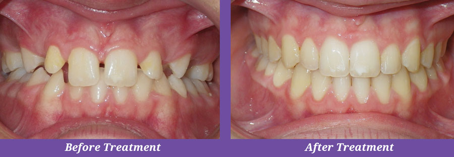 before and after treatment of teeth with gaps