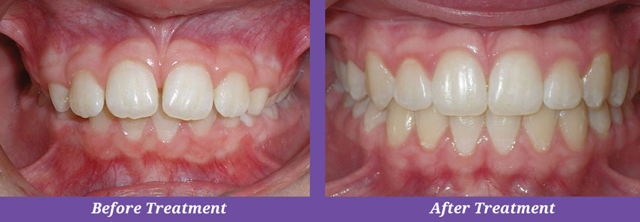 closeup of teeth before and after dental treatment