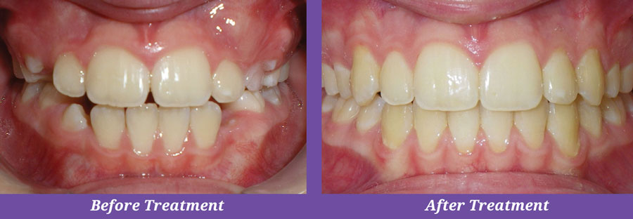 before and after orthodontic treatment of teeth