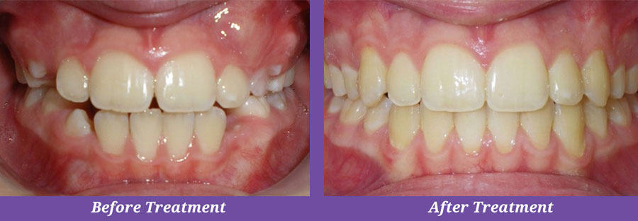 before and after photos of dental treatment