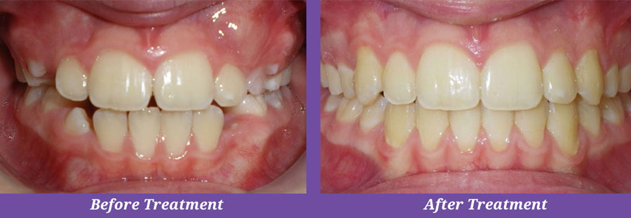 before and after photos of dental treatment