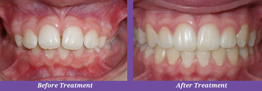 before and after orthodontic treatment for overbite