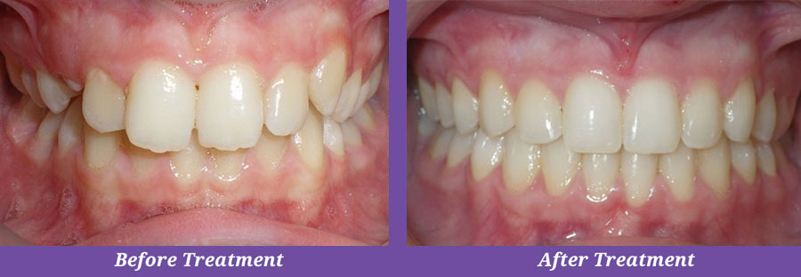 before and after photos of orthodontic treatment