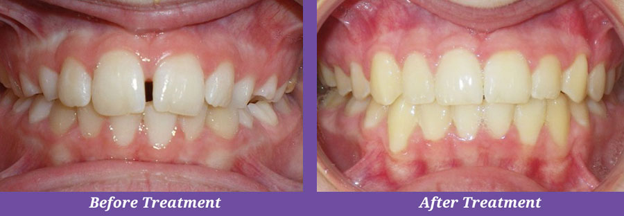 before and after orthodontic treatment of gap