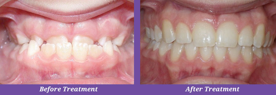 before and after orthodontic treatment of underbite