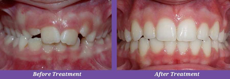 before and after orthodontic treatment of crooked teeth